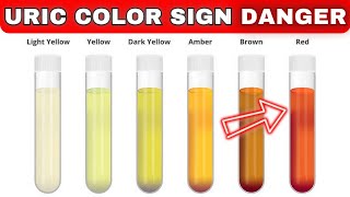 Urine Color and Your Health Danger Signs [upl. by Erotavlas22]