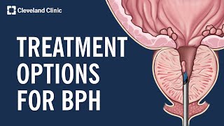 Treating Benign Prostatic Hyperplasia BPH [upl. by Cordeelia]