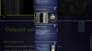 Bone tumors  Osteoid osteoma [upl. by Itram]