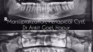 MARSUPIALIZATION Periapical Cyst Dr Ankit Goel Hapur [upl. by Lesab]