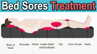 Pressure Ulcers Decubitus Ulcers Bedsores Treatment [upl. by Von]