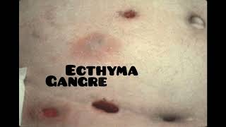 ecthyma causes symptoms and treatment dermatologyskin disease [upl. by Nitsir515]