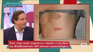 Tipos de herpes y cómo tratarlos con el Doctor Mariscal  Estando Contigo [upl. by Noirret724]