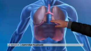 Emphysème pulmonaire [upl. by Briant]