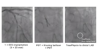 PostPCI FFR and pullback assessment for bifurcation lesion in multivessel disease [upl. by Joappa]