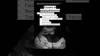 Causes of polyhydramnios [upl. by Anitsim]