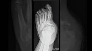 Identify the arthropathy diabetes radiology [upl. by Annot]