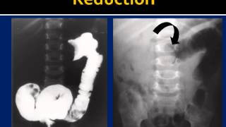 Intussusception Reduction HowTo [upl. by Latsirhc249]