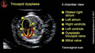 Fetal echocardiography at 1113 weeks Tricuspid Valve Dysplasia with Severe Tricuspid Regurgitation [upl. by Anehsat571]