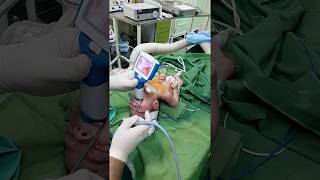 Newborn intubation using UE Miller 0 blade [upl. by Melnick527]