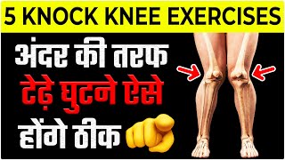 5 Best Knock Knees Correction Exercises 2023  Genu Valgum 2023 [upl. by Yetnruoc859]