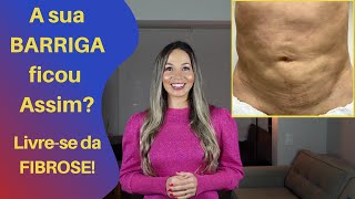 Como Acabar com a FIBROSE Antiga Mesmo Depois de 3 Anos da Cirurgia [upl. by Shira787]