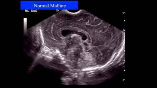 Neonatal Neurosonography The Premature Infant [upl. by Ettennal]