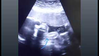 Anterior placenta with 28 weeks baby movements gender amp 3VCord  8 weeks pregnancy with heartbeat [upl. by Auberbach]