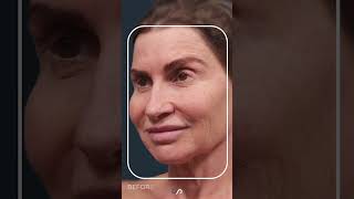 CO2 Laser Resurfacing  Facial Rejuvenation [upl. by Ikilisav743]