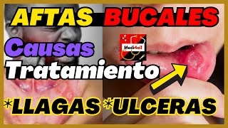 LLAGAS EN LA BOCA – Cómo curar las aftas bucales © [upl. by Kean]