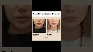 VLine Surgery Jaw Reduction and Facial Feminization 🌟 [upl. by Ardnazxela698]