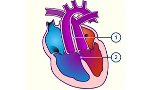 CARDIOPATHIE CONGENITALE ET INSUFFISANCE CARDIAQUE CHEZ LENFANT [upl. by Teragram]