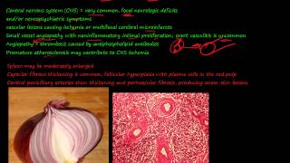 92P Morphology of Systemic lupus erythematosus SLE part 3 [upl. by Yenitirb99]