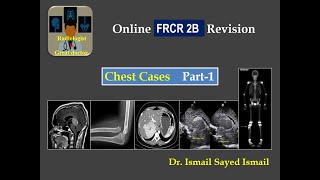 Chest Revision for FRCR 2B  Part 1 [upl. by Irehc624]