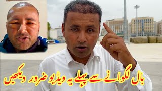 Must Watch Before Hair Transplant  Hair Transplant Complete Process and Final Results  Mubashir [upl. by Nuli66]