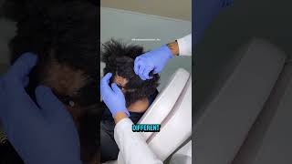 Discoid Lupus  How it Causes Permanent Hair Loss alopecia hairlossdoctor htx lupus houston [upl. by Nnahgaem]