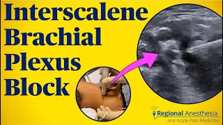 Interscalene Brachial Plexus Block [upl. by Geminius137]