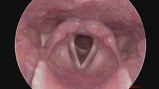 Normal Larynx Endoscopy Without Sound and No Stroboscopy [upl. by Ariaes]