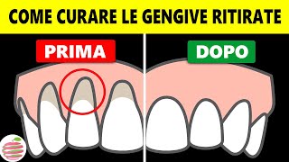 Come Trattare Le Gengive Ritirate A Casa In Modo Naturale [upl. by Ennovart4]