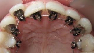 HOW BRACES WORK Awesome GOLDEN braces invisible orthodontics timelapse Incognito lingual braces [upl. by Bidget]