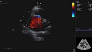 Echocardiography Essentials Mastering the parasternal short axis PSAX view of the aortic valve [upl. by Sylera]