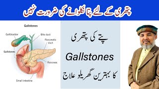 HOW ARE GALL STONES TREATED  Pitay Me Pathri Ka Ilaj  Gallstones Reasons Symptoms And Treatment [upl. by Ellehs]