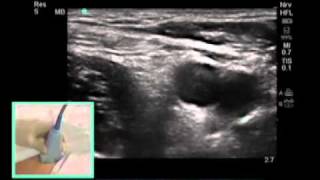 UltrasoundGuided Femoral Nerve Block  SonoSitemp4 [upl. by Gaylor]