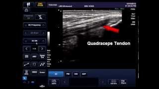 Anisotropy Ultrasound Artifact Demonstration  United Medical Instruments [upl. by Brynn]