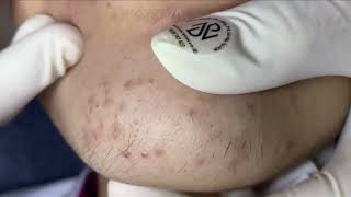 Acne On Girls Chin  Acne Treatment Nhat Bang [upl. by Rise109]