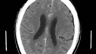 CNS C6 Leptomeningeal enhancement [upl. by Inessa]