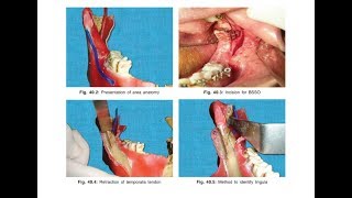 Orthognathic surgerypart 2 Mandibular Orthognathic surgical procedures [upl. by Wheelwright]