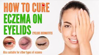 How to cure eczema on eyelids  Eyelids Dermatitis treatment and natural home remedies 2021 [upl. by Annaig314]