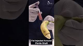 Increase Penile Shaft Girth Width with Fat Injection  Dr Amit Gupta [upl. by Adriene]