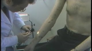 1983 REPORT Diagnosis  EARLY AIDS DOCUMENTARY [upl. by Rehpotsirk152]