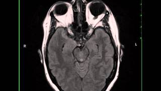 Leptomeningeal Metastatic Disease lung adenocarcinoma primary [upl. by Dnalkrik]