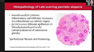 Scalp Psoriasis and Psoriatic alopecia [upl. by Tsui]