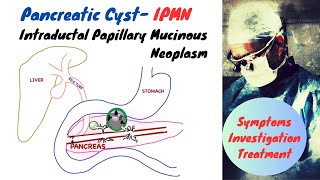 Pancreatic Cyst IPMN [upl. by Samot]