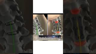 MobiC Artificial Disc Replacement Cervical Spine Surgery [upl. by Dari]