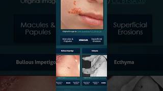 Impetigo Subtypes [upl. by Franza]