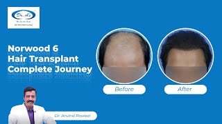 Norwood 6 Hair Transplant Before and After Results  7790 Grafts Hair Transplant  Dr Arvind Poswal [upl. by Hailahk]