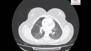 IRM du Parenchyme Pulmonaire Aspect Normal [upl. by Natie]