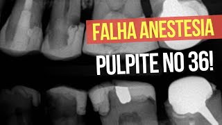 É POR ISSO QUE NÃO SE COMEÇA UMA PULPITE NO 36 COM UM TUBETE NO ALVEOLAR INFERIOR  Endolovers [upl. by Drexler]