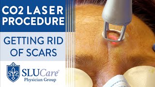 CO2 Laser Resurfacing Treatment For Getting Rid of Scars  Full Procedure [upl. by Dis]