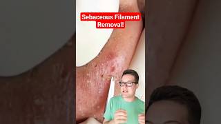 Major BLACKHEAD REMOVAL  Popping Sebaceous Filaments shorts [upl. by Fiorenze]